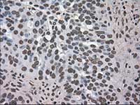 ab117984, at 1/50 dilution, staining Dihydrofolate reductase (DHFR) in paraffin-embedded Human ovary adenocarcinoma tissue by Immunohistochemistry.