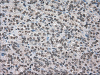 ab117984, at 1/50 dilution, staining Dihydrofolate reductase (DHFR) in paraffin-embedded Human thyroid carcinoma tissue by Immunohistochemistry.