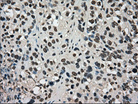 ab117984, at 1/50 dilution, staining Dihydrofolate reductase (DHFR) in paraffin-embedded Human bladder carcinoma tissue by Immunohistochemistry.