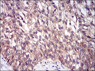 Immunohistochemical analysis of paraffin embedded Human bladder cancer tissue labeling DIS3L2 with ab181743 at 1/200.