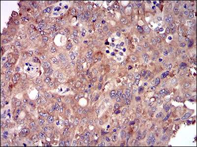 Immunohistochemical analysis of paraffin embedded Human endometrial cancer tissue labeling DIS3L2 with ab181743 at 1/200.