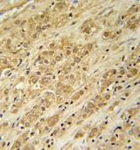 Immunohistochemical analysis of formalin-fixed paraffin-embedded Human prostate carcinoma labeling DKC1 using ab174920 at 1/50 dilution followed by peroxidase conjugation of the secondary antibody and DAB staining.