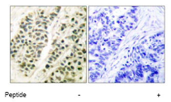 Immunohistochemical analysis of DNA Polymerase beta in paraffin embedded human breast carcinoma tissue using ab53059 at a 1/50 dilution.Left image: untreated.Right image: treated with peptide.
