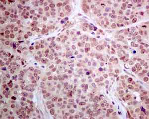 Immunohistochemical analysis of paraffin embedded Human ovarian carcinoma tissue labeling DNAJC9 with ab166612 antibody at 1/100.