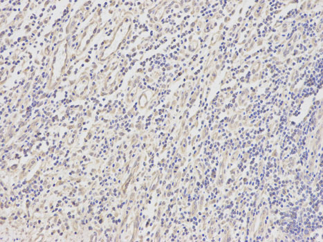 Immunohistochemistry (Formalin/PFA-fixed paraffin-embedded sections) analysis of human stomach cancer tissue labelling DOK4 with ab175624 at 1/200. Magnification: 200x.