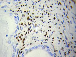 Immunohistochemical analysis of formalin-fixed paraffin-embedded Human prostate cancer tissue, labeling DOK4 using ab175624 at a 1/50 dilution.