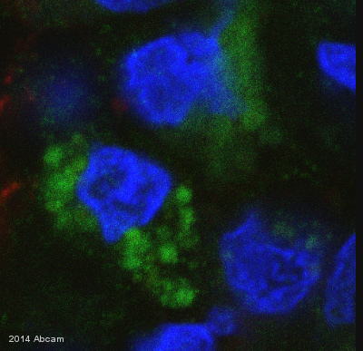ab96615 staining Dopamine beta Hydroxylase in human colorectal tumor tissue sections by Immunohistochemistry (IHC-Fr - frozen sections). Tissue was fixed with formaldehyde, permeabilized with 0.3% Triton X-100 in PBS and blocked with 5% goat serum for 1 hour at 24°C. Samples were incubated with primary antibody (1/1000) for 3 hours at 24°C. An Alexa Fluor® 488-conjugated goat anti-rabbit IgG monoclonal (1/2000) was used as the secondary antibody.See Abreview