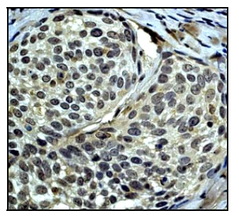 This image shows human cervical carcinoma stained with ab46811 at 1/50 dilution.