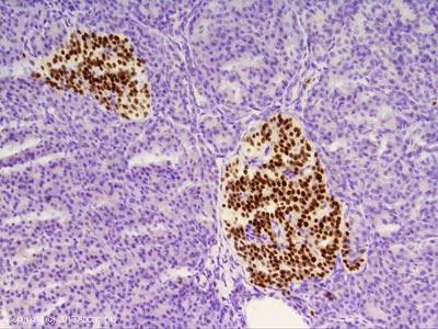 IHC image of Islet 1 staining in Human Pancreas formalin fixed paraffin embedded tissue section, performed on a Leica Bond system using the standard protocol F. The section was pre-treated using heat mediated antigen retrieval with sodium citrate buffer (pH6, epitope retrieval solution 1) for 20 mins. The section was then incubated with ab86501, 1/1000 dilution, for 15 mins at room temperature and detected using an HRP conjugated compact polymer system. DAB was used as the chromogen. The section was then counterstained with haematoxylin and mounted with DPX.