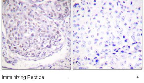 Paraffin embedded human breast carcinoma tissue labelled with ab58548 at 1/50 dilution. Samples were treated -/+ acetylated peptide.Paraffin embedded human breast carcinoma tissue labelled with ab58548 at 1/50 dilution. Samples were treated -/+ acetylated peptide.