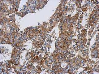 Immunohistochemical analysis of paraffin-embedded Human breast carcinoma tissue labeling Isocitrate dehydrogenase with ab154932 at 1/500.