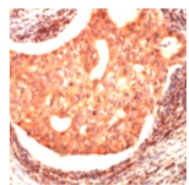 Formalin fixed/paraffin embedded uman breast carcinoma tissue stained with 1/200 ab74271 (30mins, RT).