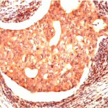 Ab37290 staining human JAB1 in breast carcinoma by immunohistochemistry with formalin fixed, paraffin embedded tissue.