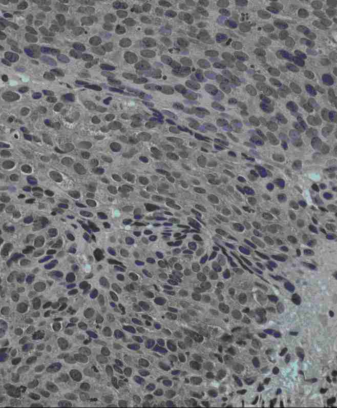 Formalin-fixed paraffin embedded IHC of human cervical cancer tissues (40x magnification) stained with ab7771 (1/100 dilution). The slides were counterstained with hematoxylin
