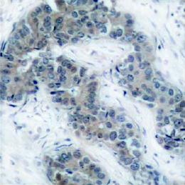 ab39396 staining human JAK2 in breast carcinoma tissue by Immunohistochemistry, Paraffin embedded tissue.