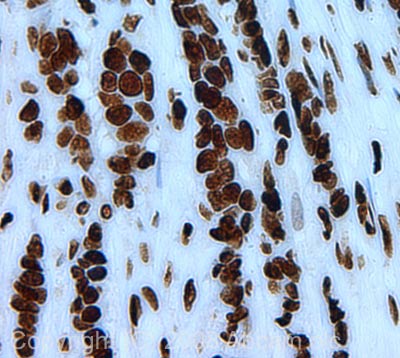 IHC image of Histone H2A (phospho S1) + Histone H4 (phospho S1) staining in human breast carcinoma FFPE section, performed on a BondTM system using the standard protocol F. The section was pre-treated using heat mediated antigen retrieval with sodium citrate buffer (pH6, epitope retrieval solution 1) for 20 mins. The section was then incubated with ab14723, 1µg/ml, for 8 mins at room temperature and detected using an HRP conjugated compact polymer system. DAB was used as the chromogen. The section was then counterstained with haematoxylin and mounted with DPX.