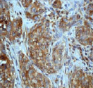 ab76125 at 1/100 dilution staining JNK2 in human breast carcinoma by Immunohistochemistry, Paraffin-embedded tissue.
