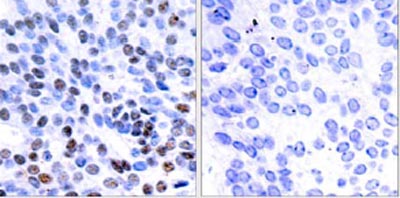 ab31421 at a 1:50-1:100 dilution, staining JunB in human breast carcinoma using Immunohistochemistry, Paraffin Embedded Tissue. Left image : Un-treated. Right image : Antibody pre-incubated with synthesized peptide.