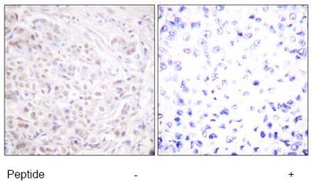 Immunohistochemical analysis of human breast carcinoma tissue using ab58550 at 1/50-1/100 dilution. Samples are treated -/+ peptide.