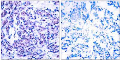 ab30631 staining human JunD in breast carcinoma by Immunohistochemistry, Paraffin embedded tissue. Left image un-treated. Right image pre-incubated with synthetic phosphopeptide.