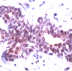 Ab41838 staining human p300 in human breast carcinoma by immunohistochemistry at 1/100 dilution using formalin fixed, paraffin embedded tissue.
