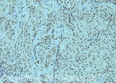 IHC image of ab70183 staining in human breast carcinoma formalin fixed paraffin embedded tissue section, performed on a Leica BondTM system using the standard protocol F. The section was pre-treated using heat mediated antigen retrieval with EDTA (pH9, epitope retrieval solution 2) for 20 mins. The section was then incubated with ab70183, 5µg/ml, for 15 mins at room temperature and detected using an HRP conjugated compact polymer system. DAB was used as the chromogen. The section was then counterstained with haematoxylin and mounted with DPX.For other IHC staining systems (automated and non-automated) customers should optimize variable parameters such as antigen retrieval conditions, primary antibody concentration and antibody incubation times.