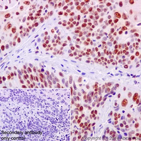 Immunohistochemical analysis of paraffin-embedded Human cervix carcinoma tissue labeling KAT8 / MYST1 / MOF with ab200660 at 1/500 dilution, followed by Goat Anti-Rabbit IgG H&L (HRP) (ab97051) secondary antibody at 1/500 dilution.Nuclear staining on Human cervix carcinoma tissue is observed.Counter stained with Hematoxylin.Secondary antibody only control: Used PBS instead of primary antibody, secondary antibody is Goat Anti-Rabbit IgG H&L (HRP) (ab97051) at 1/500 dilution.
