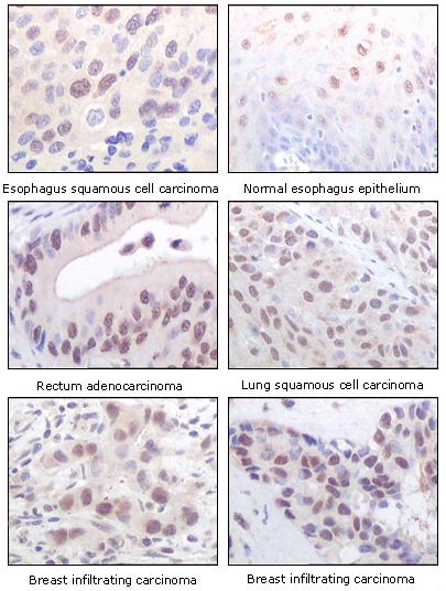 ab54276, staining MYST1/MOF in paraffin embedded human normal and tumour tissues by Immunohistochemistry. The primary antibody was diluted at 1/1000 dilution.