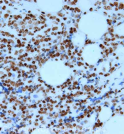 IHC image of Histone H2A X staining in human B cell lypmhoma FFPE section, performed on a BondTM system using the standard protocol F. The section was pre-treated using heat mediated antigen retrieval with sodium citrate buffer (pH6, epitope retrieval solution 1) for 20 mins. The section was then incubated with ab10475, 1µg/ml, for 8 mins at room temperature and detected using an HRP conjugated compact polymer system. DAB was used as the chromogen. The section was then counterstained with haematoxylin and mounted with DPX.