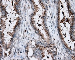 ab118145, at a 1/50 dilution, staining KCTD5 in paraffin-embedded Human colon adenocarcinoma tissue by Immunohistochemistry.