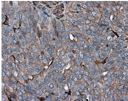 ab118145, at a 1/50 dilution, staining KCTD5 in paraffin-embedded Human ovary adenocarcinoma tissue by Immunohistochemistry.