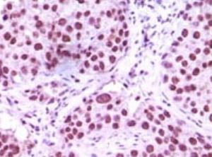 Immunohistochemical analysis of paraffin-embedded human lung carcinoma tissue, showing nuclear localisation using LSD1 antibody (ab31954) dilution 1:500-1:2000 and an HRP-conjugated secondary antibody with DAB staining.