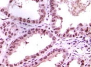 Immunohistochemical analysis of paraffin-embedded human kidney carcinoma tissue, showing nuclear localisation using LSD1 antibody (ab31954) dilution 1:500-1:2000 and an HRP-conjugated secondary antibody with DAB staining.