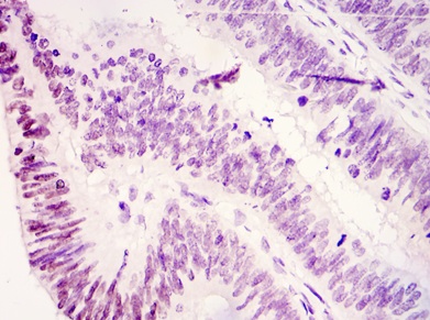 Immunohistochemical analysis of KDM3A / JHDM2A in paraffin embedded Human colonic cancer tissue, using ab107234 at a dilution of 1/200 with DAB staining.