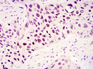 Immunohistochemical analysis of KDM3A / JHDM2A in paraffin embedded Human lung cancer tissue, using ab107234 at a dilution of 1/200 with DAB staining.