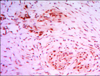 ab104831 at 1/200 dilution staining KDM4A / JHDM3A / JMJD2A in Human colon cancer by Immunohistochemistry, Paraffin-embedded tissue with DAB staining.