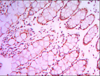 ab104831 at 1/200 dilution staining KDM4A / JHDM3A / JMJD2A in Human larynx cancer by Immunohistochemistry, Paraffin-embedded tissue with DAB staining.