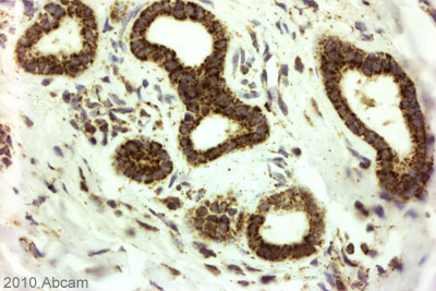ab80153 (1/1000) staining Histone H2A.Z in paraffin-embedded Human pancreatic cancer tissue. Tissue underwent fixation in formaldehyde, peroxidase blocking, protein blocking and heat mediated antigen retrieval. After the primary antibody incubation a rabbit anti-rat link was used before the application of the secondary antibody which was goat anti rabbit/mouse conjugated to HRP. For further experimental details please refer to abreview.See Abreview