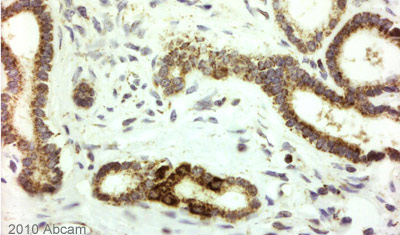 ab4462 (1/1000) staining Histone H2A.Z in paraffin-embedded Human pancreatic cancer tissue. Tissue underwent fixation in formaldehyde, peroxidase blocking, protein blocking and heat mediated antigen retrieval. After the primary antibody incubation a rabbit anti-rat link was used before the application of the secondary antibody which was goat anti rabbit/mouse conjugated to HRP. For further experimental details please refer to abreview.See Abreview