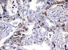 Immunohistochemical analysis of paraffin-embedded Human breast adenocarcinoma tissue labeling Ki67 with ab156956 at 1/150 dilution.