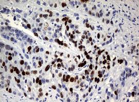 Immunohistochemical analysis of paraffin-embedded Human colon adenocarcinoma tissue labeling Ki67 with ab156956 at 1/150 dilution.