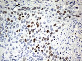 Immunohistochemical analysis of paraffin-embedded Human lung carcinoma tissue labeling Ki67 with ab156956 at 1/150 dilution.