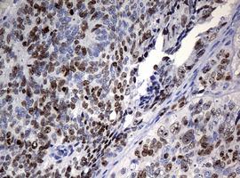 Immunohistochemical analysis of paraffin-embedded Human endometrium adenocarcinoma tissue labeling Ki67 with ab156956 at 1/150 dilution.