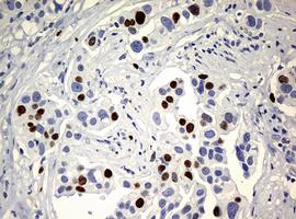 Immunohistochemical analysis of paraffin-embedded Human bladder carcinoma tissue labeling Ki67 with ab156956 at 1/150 dilution.