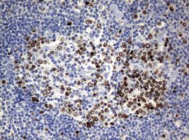 Immunohistochemical analysis of paraffin-embedded Human lymphoma tissue labeling Ki67 with ab156956 at 1/150 dilution.