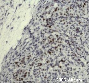 IHC-P image of ab8191 (1/50) staining human melanoma tumour sections. Secondary antibody: anti-mouse HRP (ab6728).See Abreview