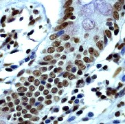 Immunohistochemical analysis of paraffin-embedded human colon carcinoma, using anti-Histone H2B ab40883 at a 1:250 dilution.Immunohistochemical analysis of paraffin-embedded human colon carcinoma, using anti-Histone H2B ab40883 at a 1:250 dilution.
