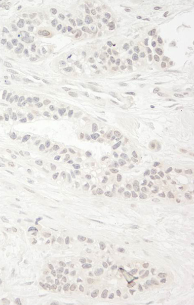 Immunohistochemistry (Formalin/PFA-fixed paraffin-embedded sections) analysis of human breast carcinoma tissue labelling KIF14 with ab71155 at 1/200 (1µg/ml). Detection: DAB.