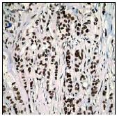 Ab62335 (1/100-1/250) staining human Histone H2B in human breast carcinoma tissue by immunohistochemistry using paraffin embededd tissue.