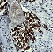 ab52988 at 1/250-1/500 dilution staining Histone H2B in human cervical carcinoma by Immunohistochemistry, Paraffin embedded tissue.